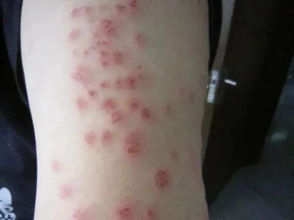 慎点!可随衣服行李传播!多国爆发床虱危机,已传入亚洲